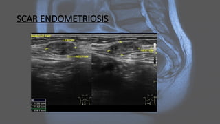 SCAR ENDOMETRIOSIS
 