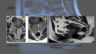 MRI
SHADING SIGN MUSHROOM CAP SIGN OF RECTOSIGMOID
ENDOMETRIOSIS
 