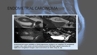 ENDOMETRIAL CARCINOMA
 