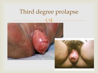 Third degree prolapse
         
 
