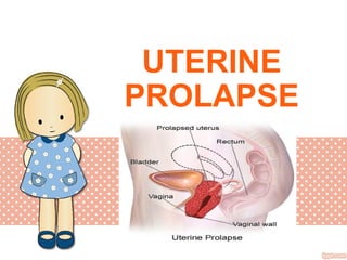 UTERINE
PROLAPSE
 