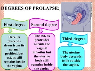 DEGREES OF PROLAPSE:
First degree Second degree
Third degreeHere Us
descends
down from its
normal
position, but
ext. os still
remains inside
the vagina
The ext. os
protrudes
outside the
vaginal
introitus but
the uterine
body still
remains inside
the vagina
The uterine
body descends
to lie outside
the vagina.
 