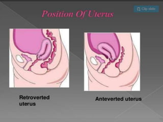 Uterine prolapse