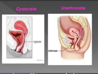 Uterine prolapse