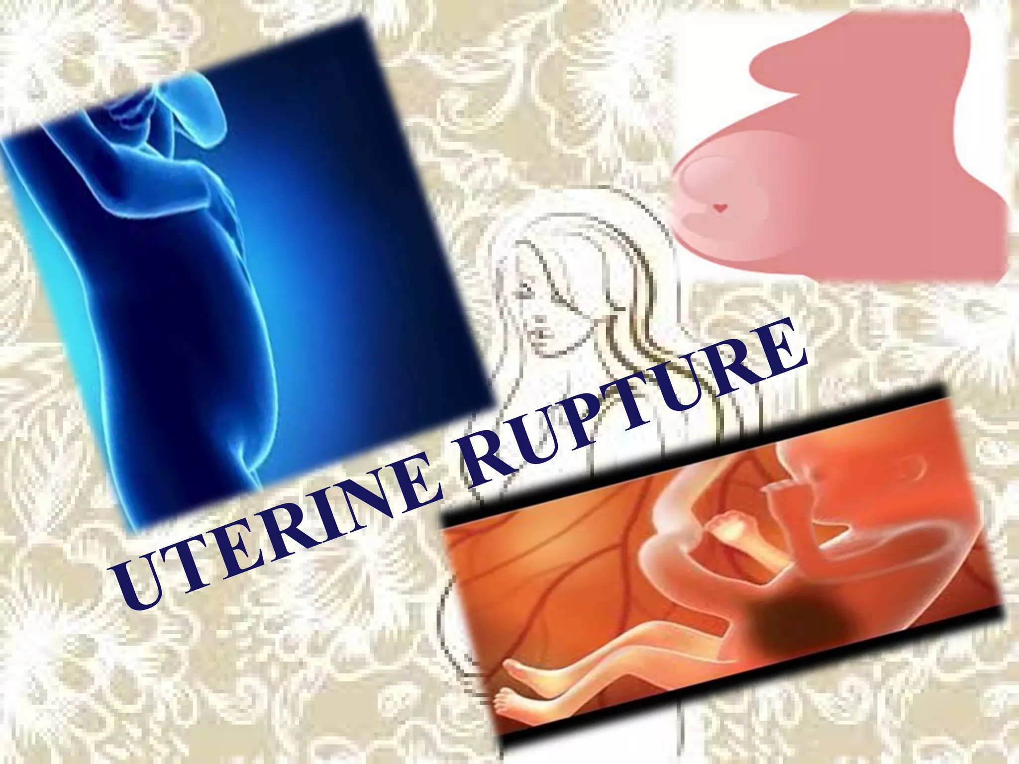 Uterine rupture PPT