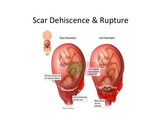 Uterine Rupture OSCE