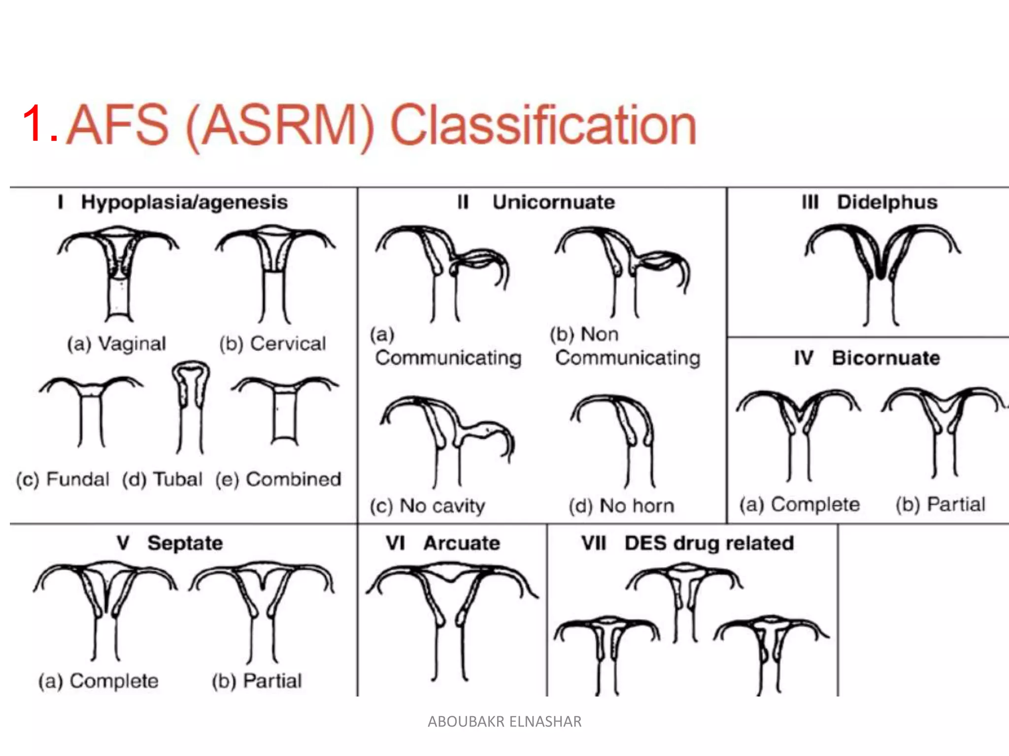Uterine septum ASRM GUIDELINES2016 | PPT