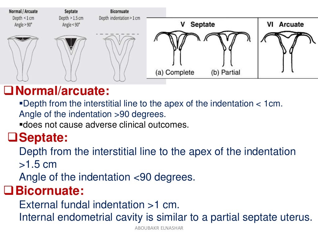 Uterine septum ASRM GUIDELINES2016
