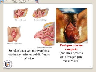 “Curso del Sistema Reproductor Humano:
            Mitos y verdades”




                                         Prolapso uterino
   Se relacionan con retroversiones          completo
   uterinas y lesiones del diafragma     (haz click derecho
                pélvico.                 en la imagen para
                                            ver el video)
                                                              31
 