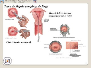 “Curso del Sistema Reproductor Humano:
            Mitos y verdades”



Toma de biopsia con pinza de Pozzi

                                          Haz click derecho en la
                                         imagen para ver el video




 Conización cervical




                                                                    32
 