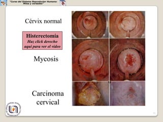“Curso del Sistema Reproductor Humano:
            Mitos y verdades”




            Cérvix normal

             Histerectomía
             Haz click derecho
           aquí para ver el video


                   Mycosis



                 Carcinoma
                  cervical
                                         33
 