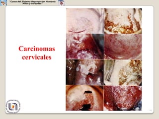 “Curso del Sistema Reproductor Humano:
            Mitos y verdades”




       Carcinomas
        cervicales




                                         34
 