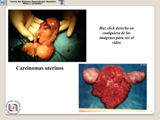 “Curso del Sistema Reproductor Humano:
            Mitos y verdades”




                                         Haz click derecho en
                                           cualquiera de las
                                         imágenes para ver el
                                                 video




     Carcinomas uterinos




                                                                36
 