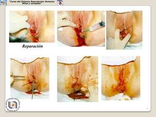 “Curso del Sistema Reproductor Humano:
            Mitos y verdades”




          Reparación




                                         41
 