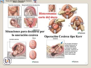 “Curso del Sistema Reproductor Humano:
            Mitos y verdades”




                                         Histerotomía:
                                         corte del útero



Situaciones para decidirse por
     la operación cesárea     Operación Cesárea tipo Kerr




                                                            42
 