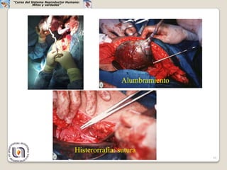 “Curso del Sistema Reproductor Humano:
            Mitos y verdades”




                                                   Alumbramiento




                                   Histerorrafía: sutura
                                                                   44
 