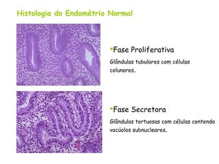 Histologia do Endométrio Normal



                        Fase Proliferativa
                        Glândulas tubulares com células
                        colunares.




                        Fase Secretora
                        Glândulas tortuosas com células contendo
                        vacúolos subnucleares.
 