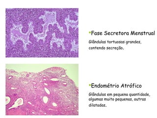 Fase Secretora Menstrual
Glândulas tortuosas grandes,
contendo secreção.




Endométrio Atrófico
Glândulas em pequena quantidade,
algumas muito pequenas, outras
dilatadas.
 