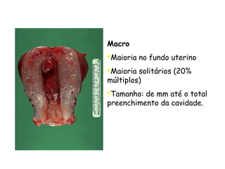 Macro
Maioria no fundo uterino
Maioria solitários (20%
múltiplos)
Tamanho: de mm até o total
preenchimento da cavidade.
 