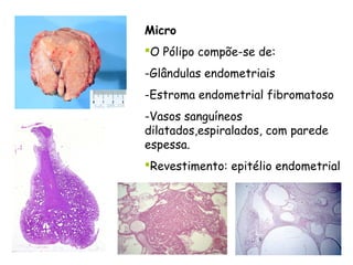 Micro
O Pólipo compõe-se de:
-Glândulas endometriais
-Estroma endometrial fibromatoso
-Vasos sanguíneos
dilatados,espiralados, com parede
espessa.
Revestimento: epitélio endometrial
 