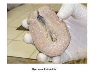 Hiperplasia Endometrial
 