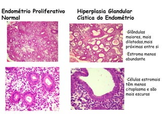 Endométrio Proliferativo   Hiperplasia Glandular
Normal                     Cística do Endométrio

                                            •Glândulas
                                            maiores, mais
                                            dilatadas,mais
                                            próximas entre si
                                            •Estroma menos
                                            abundante




                                            •Células estromais
                                            têm menos
                                            citoplasma e são
                                            mais escuras
 