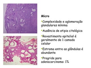 Micro
Complexidade e aglomeração
glandulares mínima
Ausência de atipia citológica
Revestimento epitelial é
geralmente de 1 camada
celular
Estroma entre as glândulas é
abundante
Progride para
adenocarcinoma: 1%
 