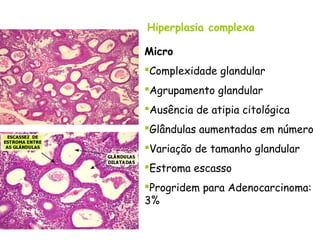 Hiperplasia complexa

Micro
Complexidade glandular
Agrupamento glandular
Ausência de atipia citológica
Glândulas aumentadas em número
Variação de tamanho glandular
Estroma escasso
Progridem para Adenocarcinoma:
3%
 