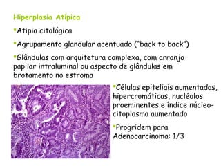 Hiperplasia Atípica
Atipia citológica
Agrupamento glandular acentuado (“back to back”)
Glândulas com arquitetura complexa, com arranjo
papilar intraluminal ou aspecto de glândulas em
brotamento no estroma
                           Células epiteliais aumentadas,
                           hipercromáticas, nucléolos
                           proeminentes e índice núcleo-
                           citoplasma aumentado
                           Progridem para
                           Adenocarcinoma: 1/3
 