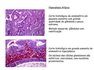 Hiperplasia Atípica


Corte histológico de endométrio em
pequeno aumento com grande
quantidade de glândulas e pouco
estroma.
Metade esquerda: glândulas com
ramificação




Corte histológico em grande aumento de
endométrio hiperplásico.
Os núcleos das células glandulares são
esféricos, vesiculosos, com nucléolos
proeminentes.
 