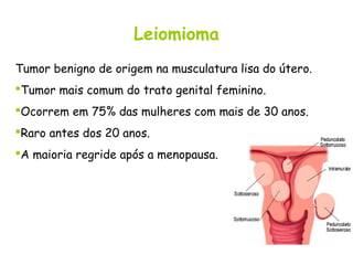 Leiomioma
Tumor benigno de origem na musculatura lisa do útero.
Tumor mais comum do trato genital feminino.
Ocorrem em 75% das mulheres com mais de 30 anos.
Raro antes dos 20 anos.
A maioria regride após a menopausa.
 