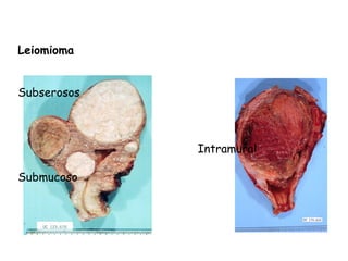 Leiomioma


Subserosos



             Intramural

Submucoso
 