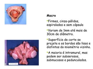 Macro
Firmes, cinza-pálidos,
espiralados e sem cápsula
Variam de 1mm até mais de
30cm de diâmetro.
Superfície de corte se
projeta e os bordos são lisos e
distintos do miométrio vizinho.
A maioria é intramural, mas
podem ser subserosos,
submucosos e pedunculados.
 