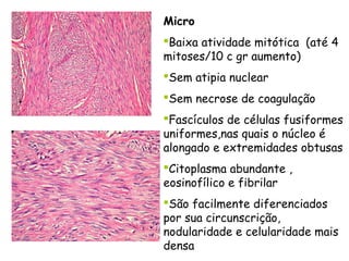 Micro
Baixa atividade mitótica (até 4
mitoses/10 c gr aumento)
Sem atipia nuclear
Sem necrose de coagulação
Fascículos de células fusiformes
uniformes,nas quais o núcleo é
alongado e extremidades obtusas
Citoplasma abundante ,
eosinofílico e fibrilar
São facilmente diferenciados
por sua circunscrição,
nodularidade e celularidade mais
densa
 