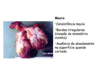 Macro
Consistência macia
Bordas irregulares
(invasão do miométrio
vizinho)
Ausência de abaulamento
na superfície quando
cortado
 