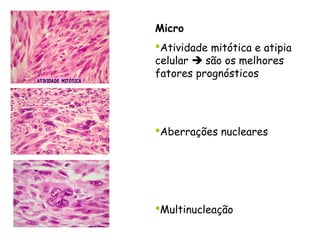 Micro
Atividade mitótica e atipia
celular  são os melhores
fatores prognósticos




Aberrações nucleares




Multinucleação
 