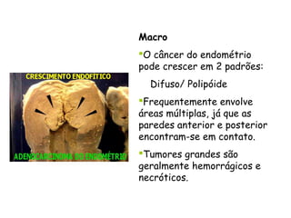 Macro
O câncer do endométrio
pode crescer em 2 padrões:
  Difuso/ Polipóide
Frequentemente envolve
áreas múltiplas, já que as
paredes anterior e posterior
encontram-se em contato.
Tumores grandes são
geralmente hemorrágicos e
necróticos.
 