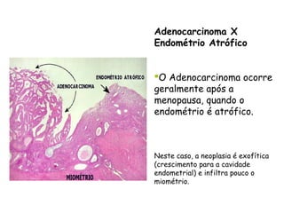 Adenocarcinoma X
Endométrio Atrófico


O Adenocarcinoma ocorre
geralmente após a
menopausa, quando o
endométrio é atrófico.



Neste caso, a neoplasia é exofítica
(crescimento para a cavidade
endometrial) e infiltra pouco o
miométrio.
 