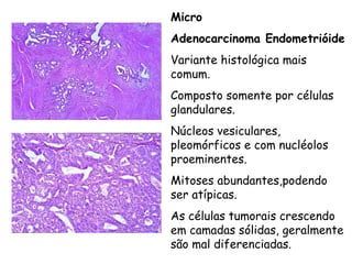 Micro
Adenocarcinoma Endometrióide
Variante histológica mais
comum.
Composto somente por células
glandulares.
Núcleos vesiculares,
pleomórficos e com nucléolos
proeminentes.
Mitoses abundantes,podendo
ser atípicas.
As células tumorais crescendo
em camadas sólidas, geralmente
são mal diferenciadas.
 