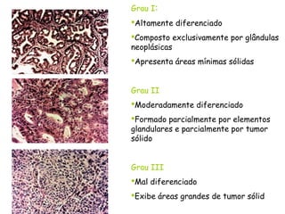 Grau I:
Altamente diferenciado
Composto exclusivamente por glândulas
neoplásicas
Apresenta áreas mínimas sólidas


Grau II
Moderadamente diferenciado
Formado parcialmente por elementos
glandulares e parcialmente por tumor
sólido


Grau III
Mal diferenciado
Exibe áreas grandes de tumor sólid
 