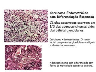 Carcinoma Endometrióide
com Diferenciação Escamosa
Células escamosas ocorrem em
1/3 dos adenocarcinomas além
das células glandulares.

Carcinoma Adenoescamoso: O tumor
inclui componentes glandulares malignos
e elementos escamosos.




Adenocarcinoma bem diferenciado com
focos de metaplasia escamosa benigna.
 