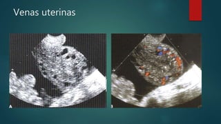 Venas uterinas
 
