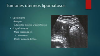  Lipoleimioma
 Benigno
 Adipocitos musculo y tejido fibroso
 Ecograficamente
 Masa ecogenica en:
 Miometrio
 Dopler ausencia de flujo
Tumones uterinos lipomatosos
 