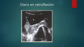 Útero en retroflexión
 