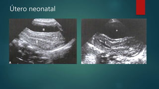Útero neonatal
 