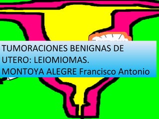 TUMORACIONES BENIGNAS DE
UTERO: LEIOMIOMAS.
MONTOYA ALEGRE Francisco Antonio
 