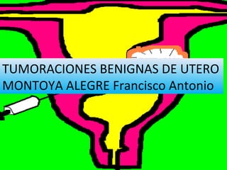 TUMORACIONES BENIGNAS DE UTERO
MONTOYA ALEGRE Francisco Antonio
 