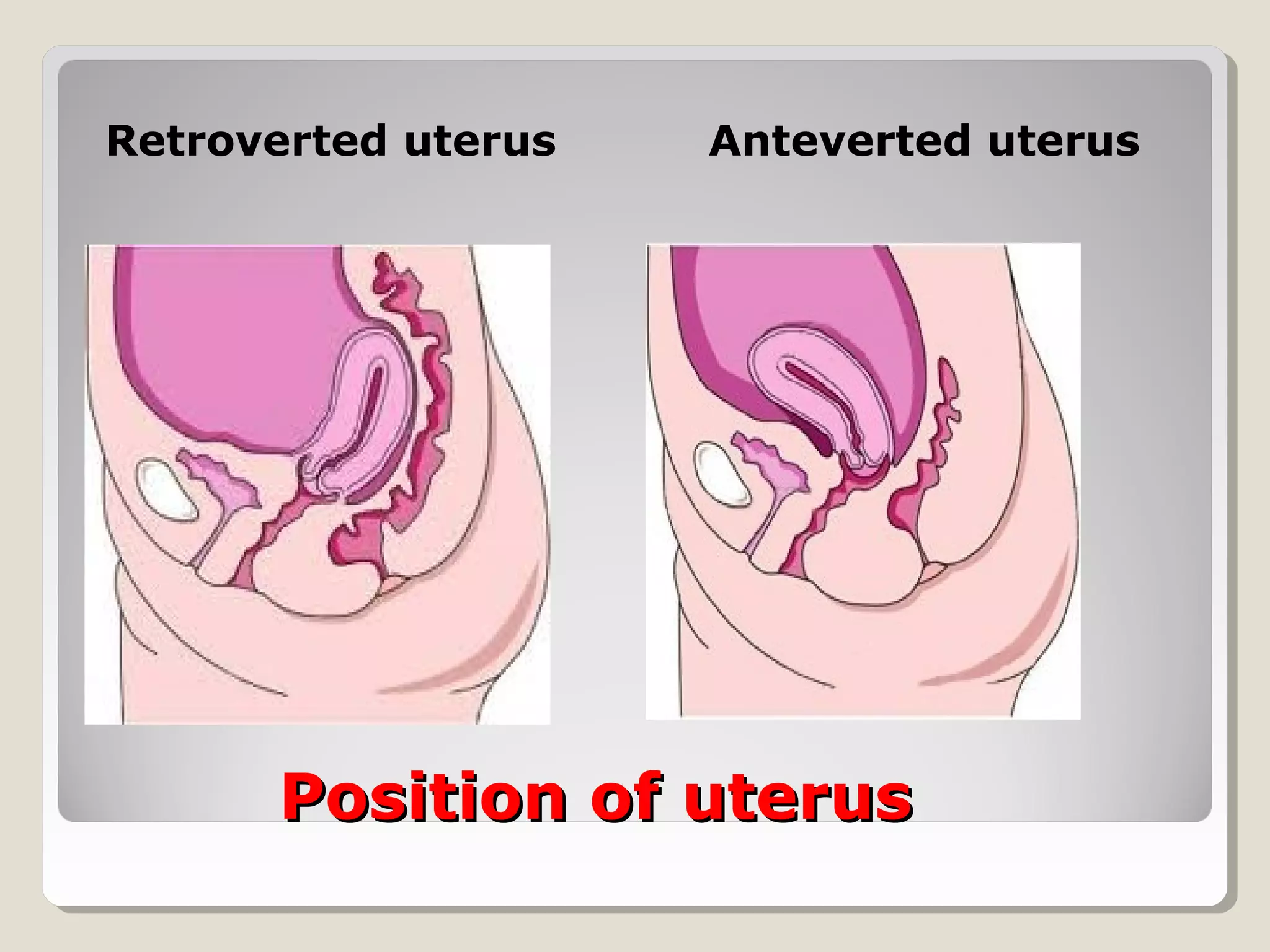Utero vaginal prolapse PPT