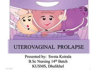 UTEROVAGINAL PROLAPSE
Presented by: Sweta Koirala
B.Sc Nursing 14th Batch
KUSMS, Dhulikhel 18/31/2020
 
