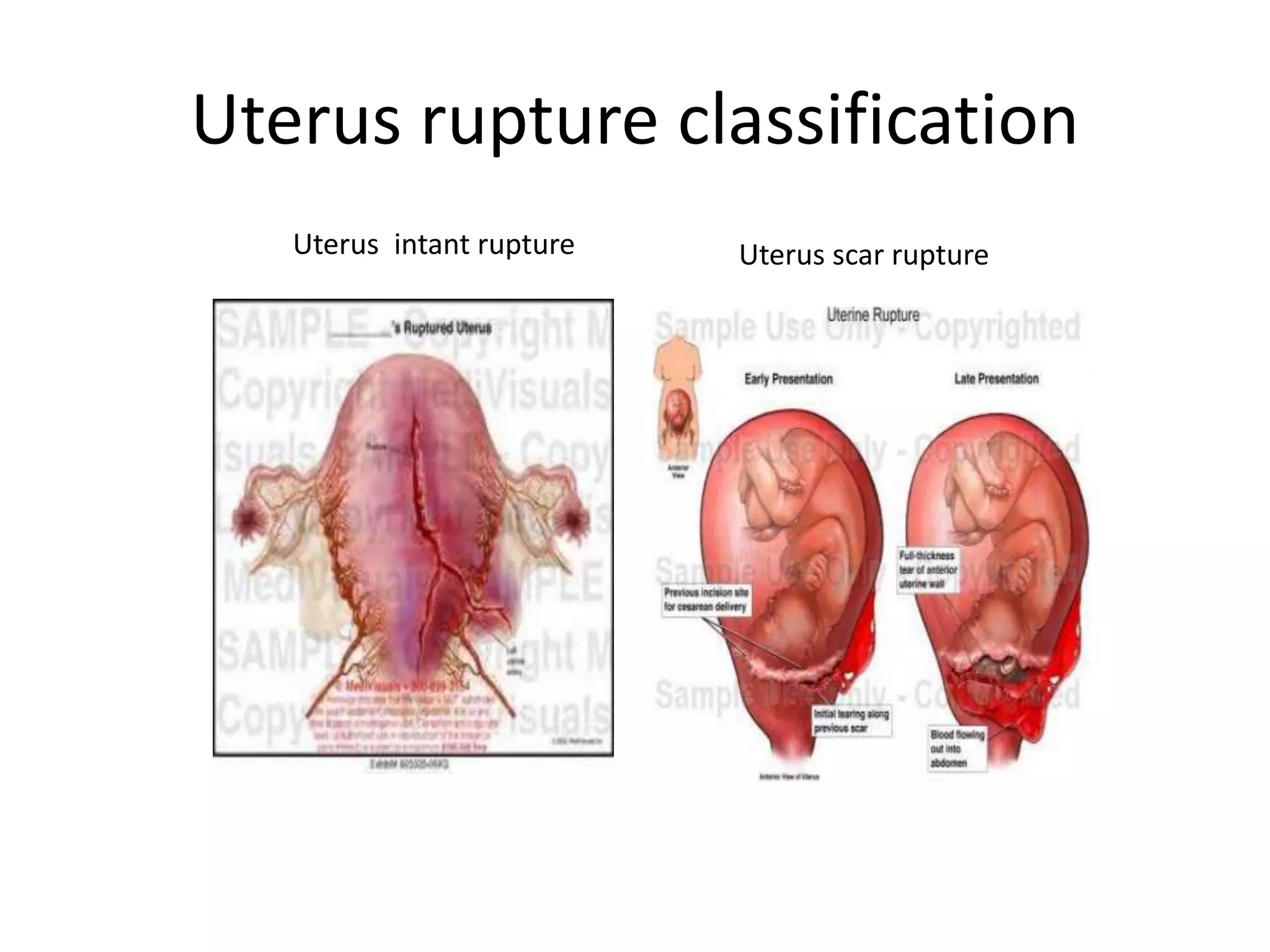 Ruptural Uterus rupture and uterus cervix rupture | PPTX